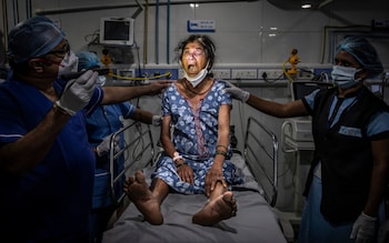 Medics examine a patient with ‘black fungus’, a superbug that infiltrated Covid wards in hospitals across India in 2021